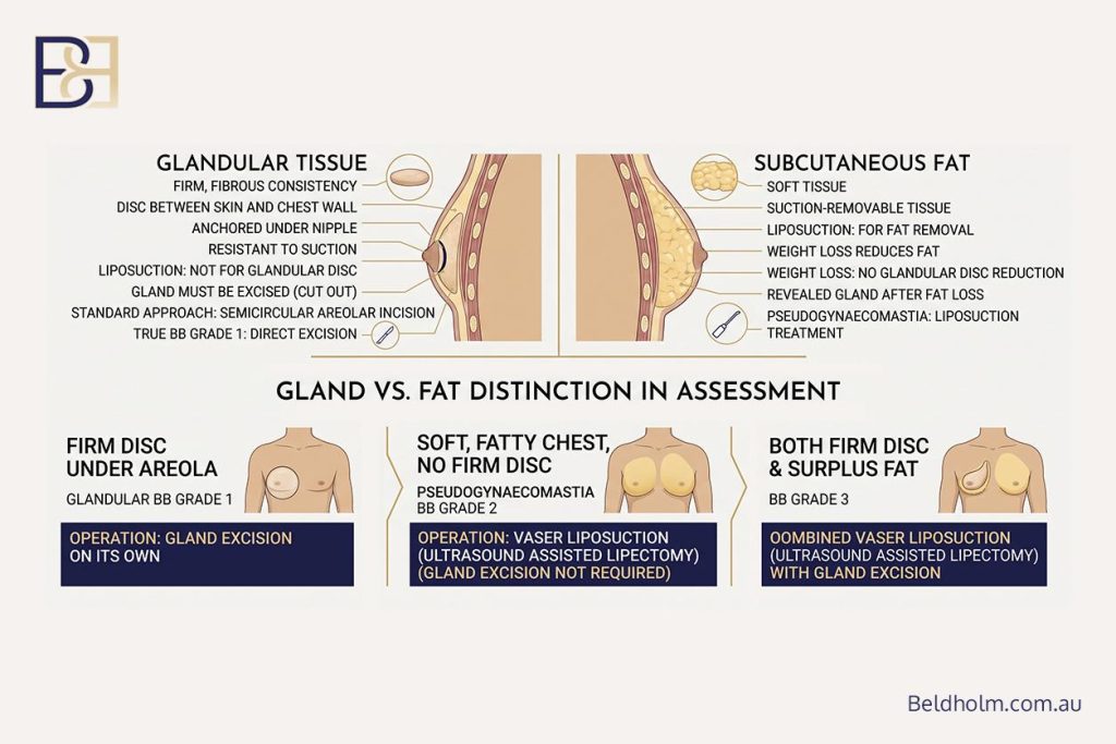 Gland vs fat distinction