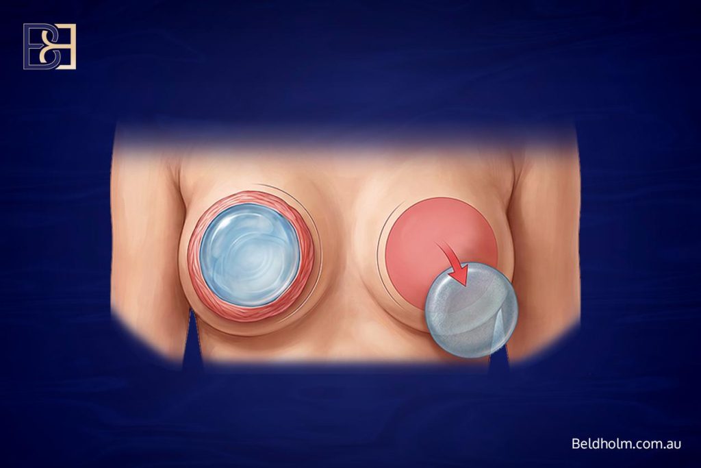 Breast Implant Removal