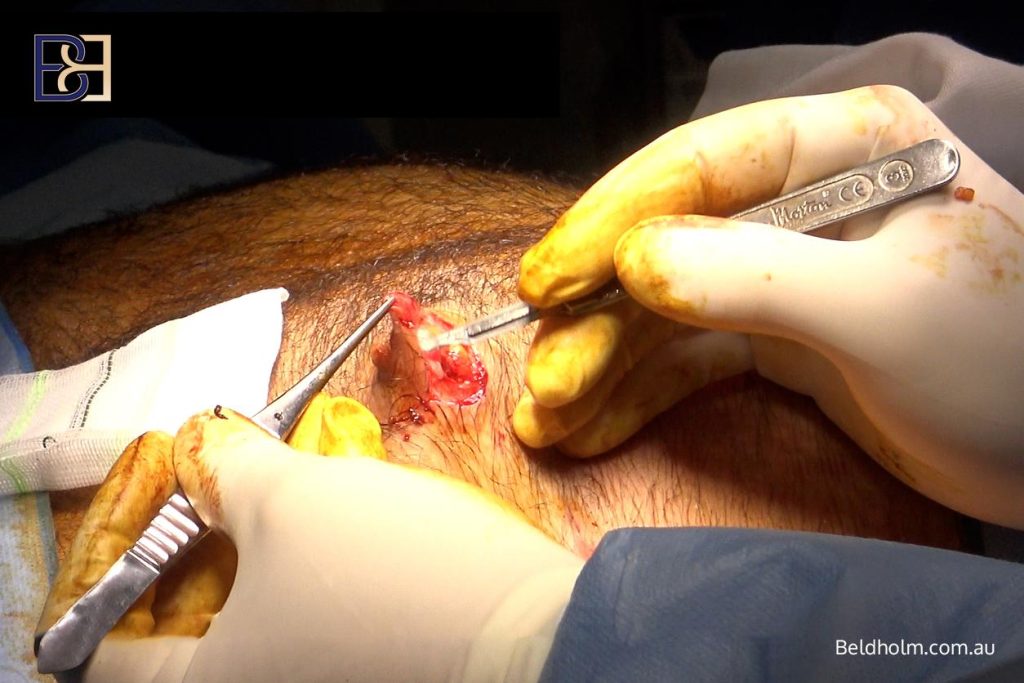 Initial incision in gynaecomastia surgery