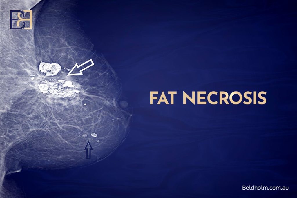 Complications of Breast Implant Removal (Explant Surgery) With a Breast Lift (Mastopexy) 12 Fat Necrosis