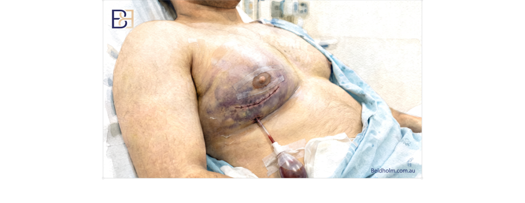 Haematoma