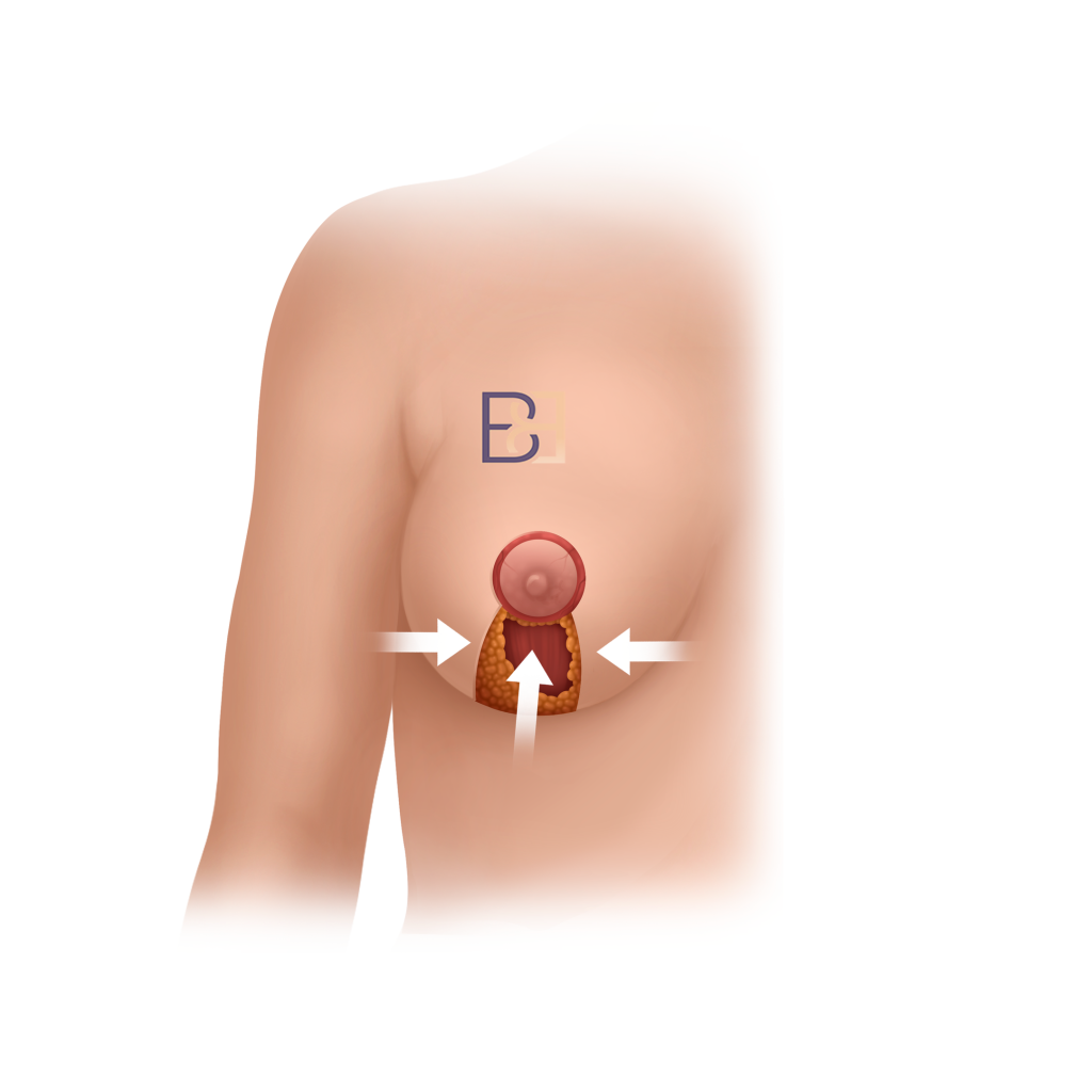 Nipple and areola blood supply, and the risk of tissue loss