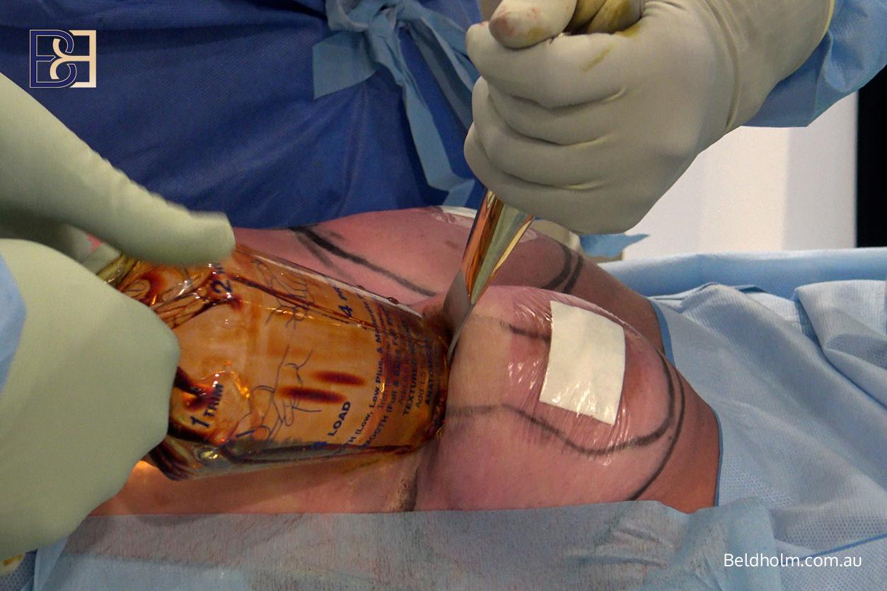 Inserting new Breast implant