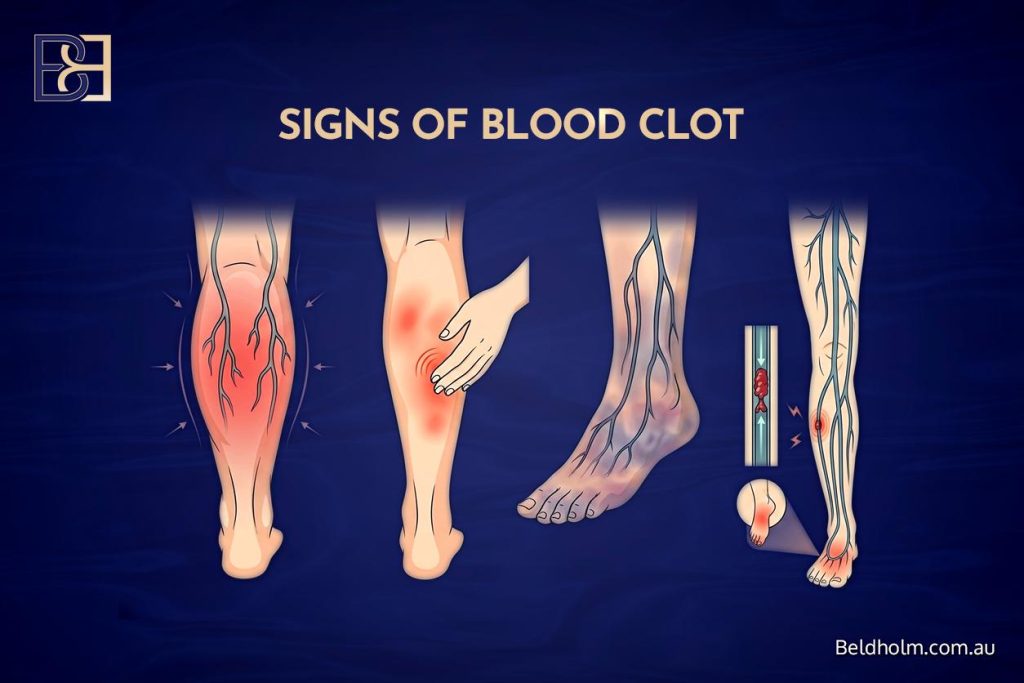 Complications of Breast Implant Removal (Explant Surgery) With a Breast Lift (Mastopexy) 23 Signs of Blood Clot
