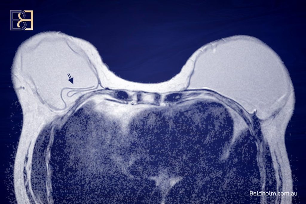 How common breast implant rupture is