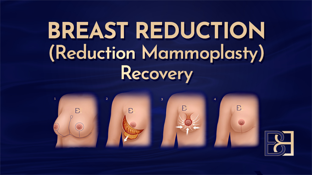 Breast Reduction (Reduction Mammoplasty) Recovery