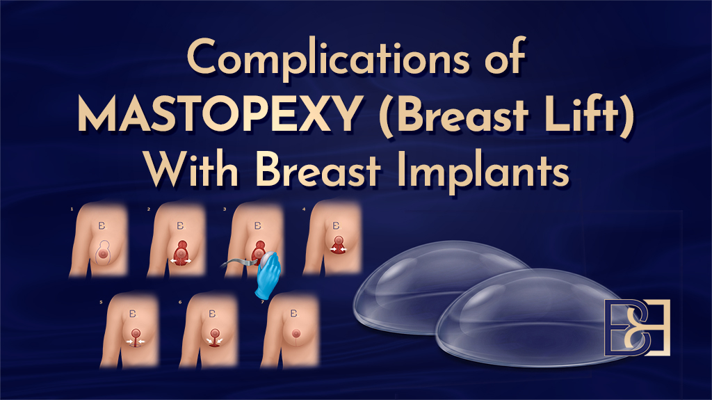 Complications of Mastopexy (Breast Lift) With Breast Implants