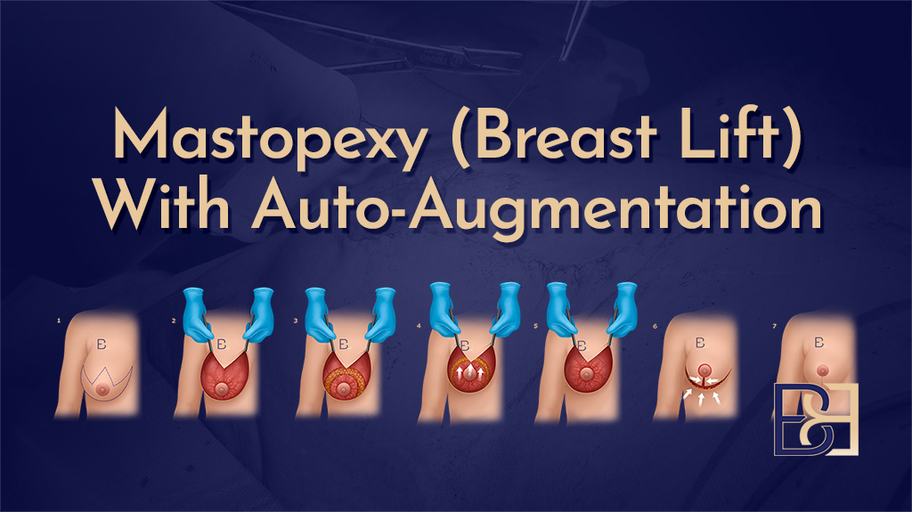 Mastopexy (Breast Lift) With Auto-Augmentation)-featured image