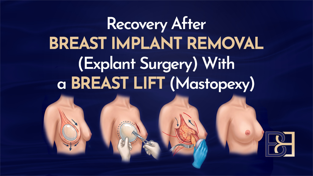 Recovery After Breast Implant Removal (Explant Surgery) With a Breast Lift (Mastopexy)