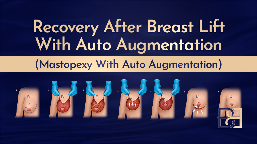 Recovery After Breast Lift With Auto Augmentation (Mastopexy With Auto Augmentation) - Featured Image