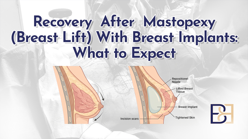 Recovery After Mastopexy (Breast Lift) With Breast Implants - Featured Image
