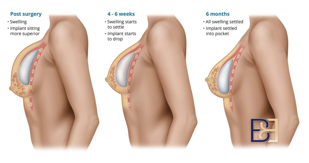 The following months: settling into shape