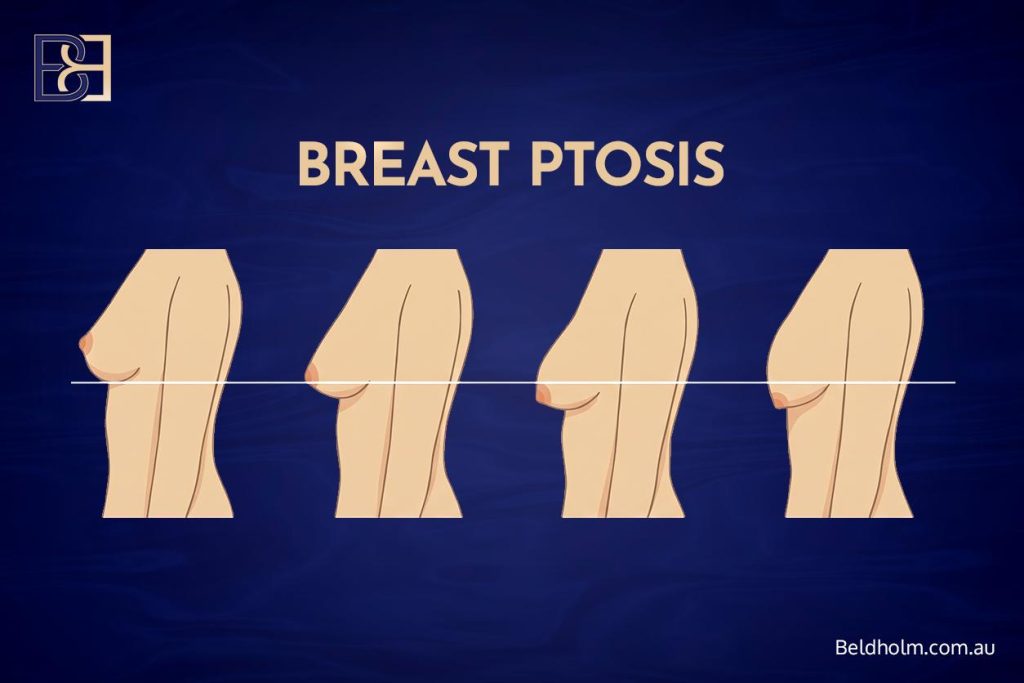 Complications of Breast Implant Removal (Explant Surgery) With a Breast Lift (Mastopexy) 21 breast ptosis