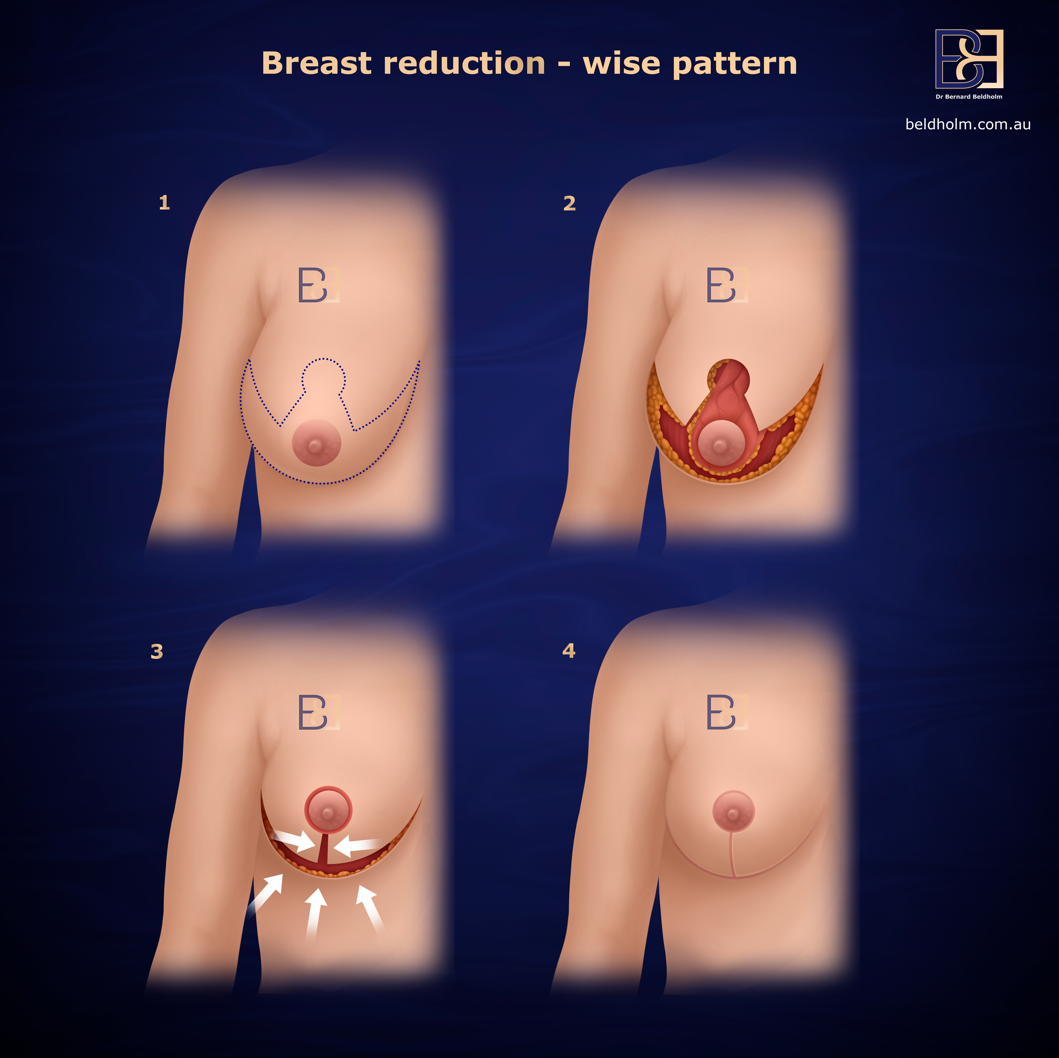 Breast Reduction Wise Pattern
